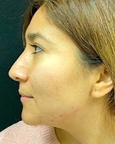 Rhinoplasty case #4965