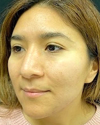 Rhinoplasty case #4965