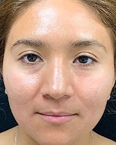 Rhinoplasty case #4965