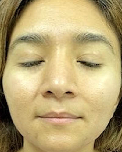 Rhinoplasty case #4965