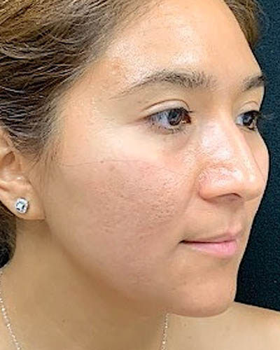 Rhinoplasty case #4965