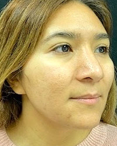 Rhinoplasty case #4965