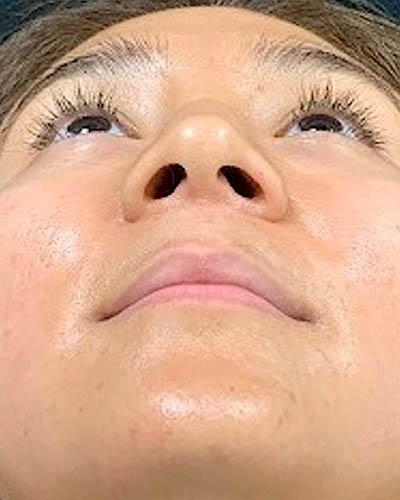 Rhinoplasty case #4965