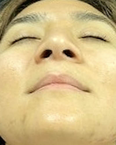 Rhinoplasty case #4965