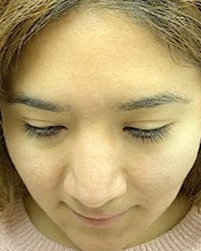 Rhinoplasty case #4965