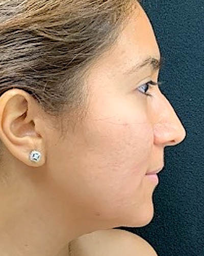 Rhinoplasty case #4965