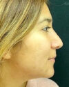 Rhinoplasty case #4965