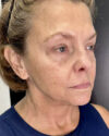 Facial Rejuvenation case #4860