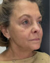 Facial Rejuvenation case #4860