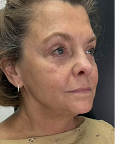 Facial Rejuvenation case #4860