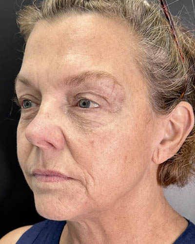 Facial Rejuvenation case #4860