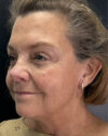 Facial Rejuvenation case #4860