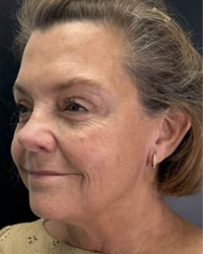 Facial Rejuvenation case #4860
