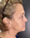 Facial Rejuvenation case #4860