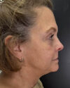 Facial Rejuvenation case #4860