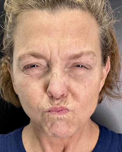 Facial Rejuvenation case #4860