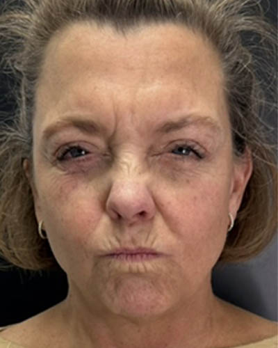 Facial Rejuvenation case #4860
