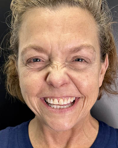 Facial Rejuvenation case #4860