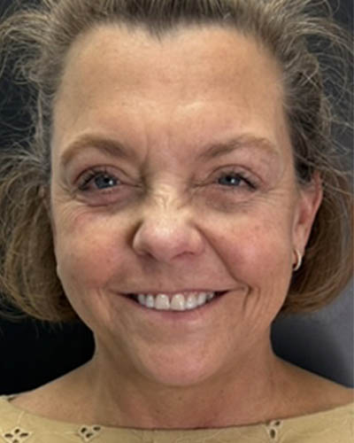 Facial Rejuvenation case #4860