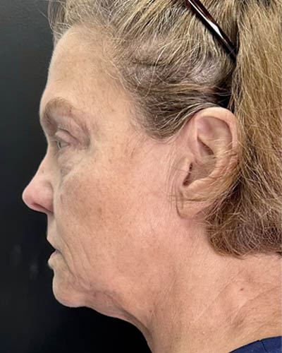 Facial Rejuvenation case #4860