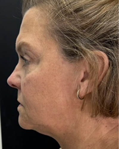 Facial Rejuvenation case #4860