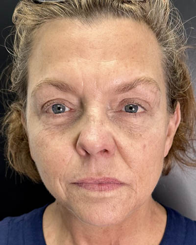 Facial Rejuvenation case #4860