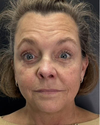 Facial Rejuvenation case #4860