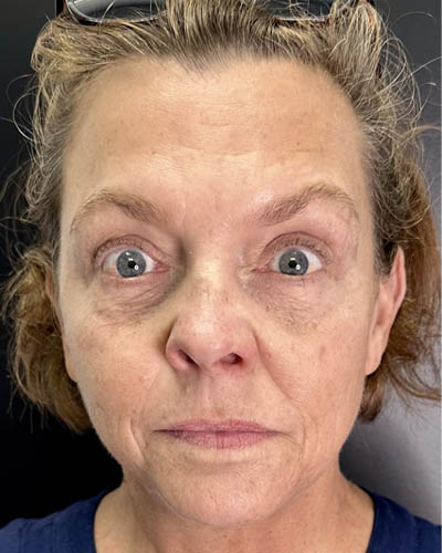 Facial Rejuvenation case #4860