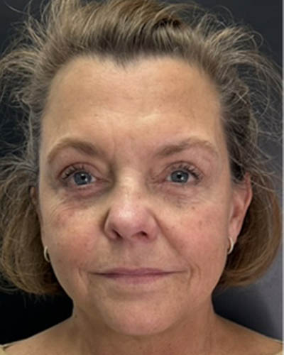 Facial Rejuvenation case #4860