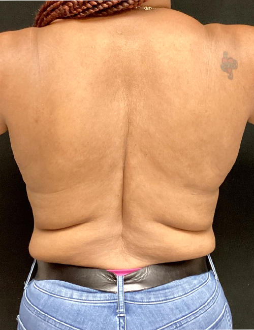 Body Lift case #5056