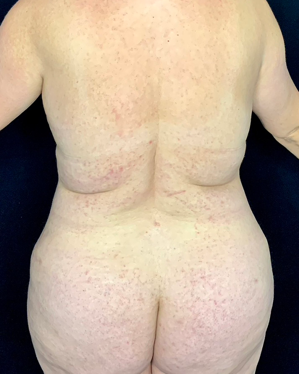 Liposuction case #5165