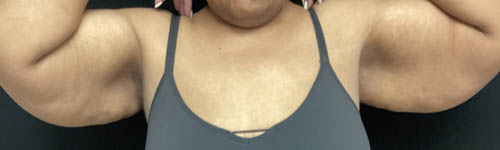 Arm Lift case #5006