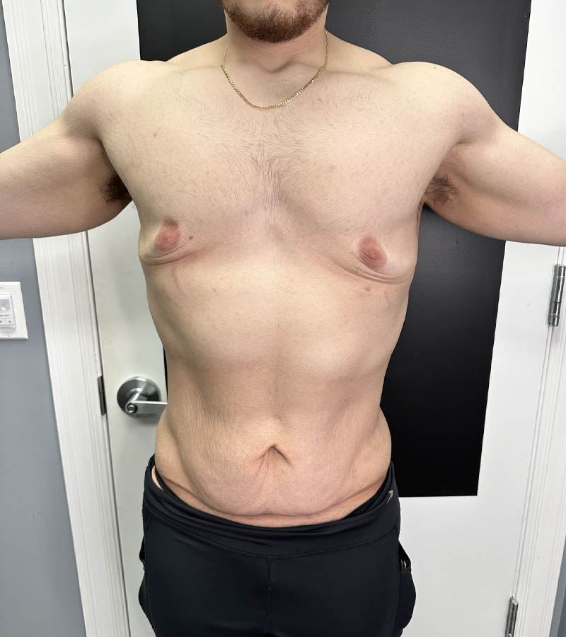 Gynecomastia case #5085