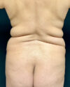 Liposuction case #5172