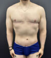 Gynecomastia case #5085