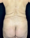 Liposuction case #5172