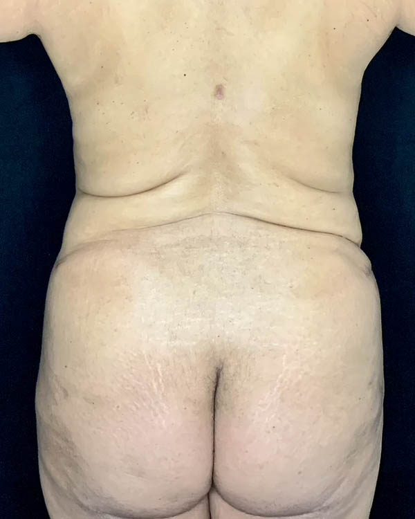 Liposuction case #5172