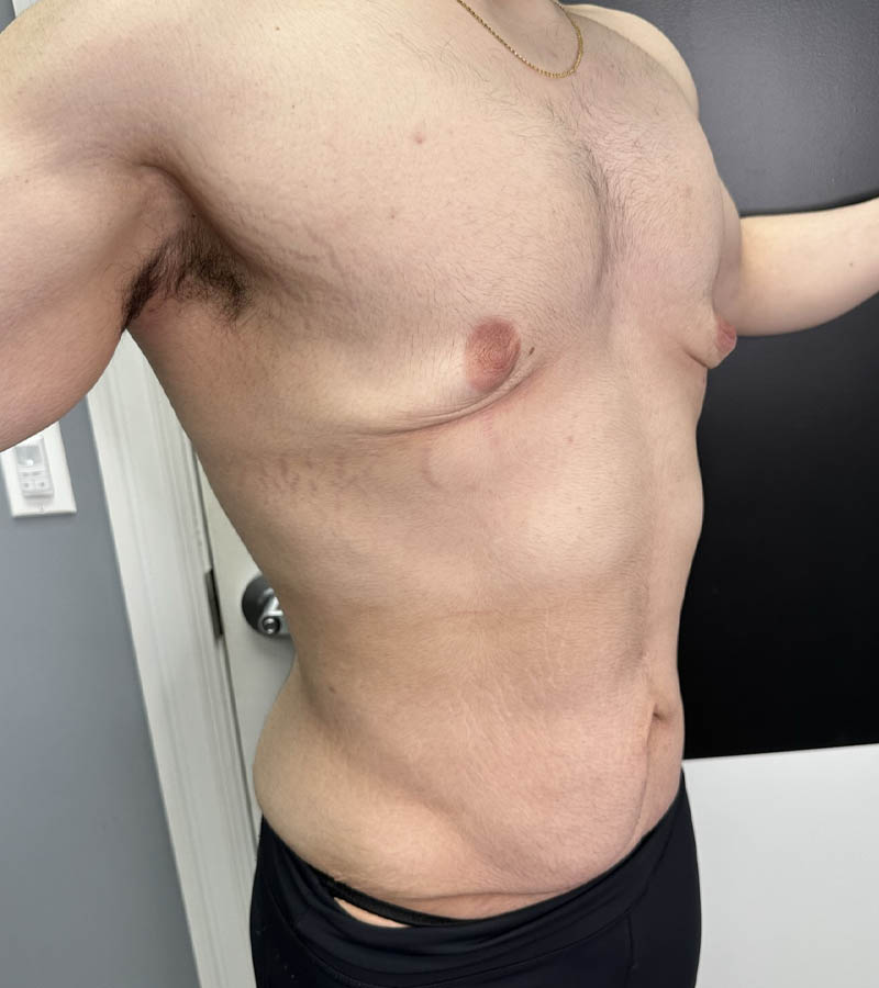 Gynecomastia case #5085