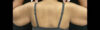 Arm Lift case #5006