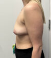 Breast Augmentation case #5026