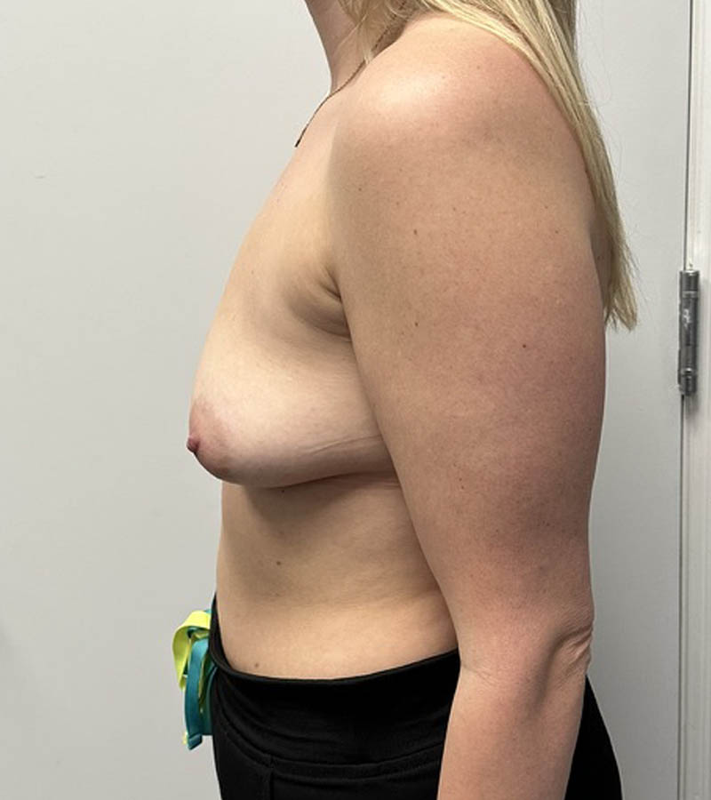 Breast Augmentation case #5026