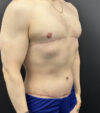 Gynecomastia case #5085