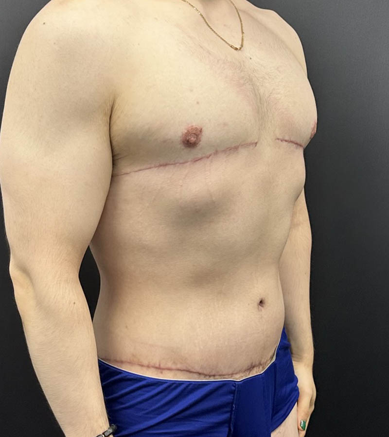 Gynecomastia case #5085