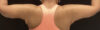 Arm Lift case #5006
