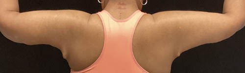 Arm Lift case #5006