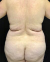 Liposuction case #5165