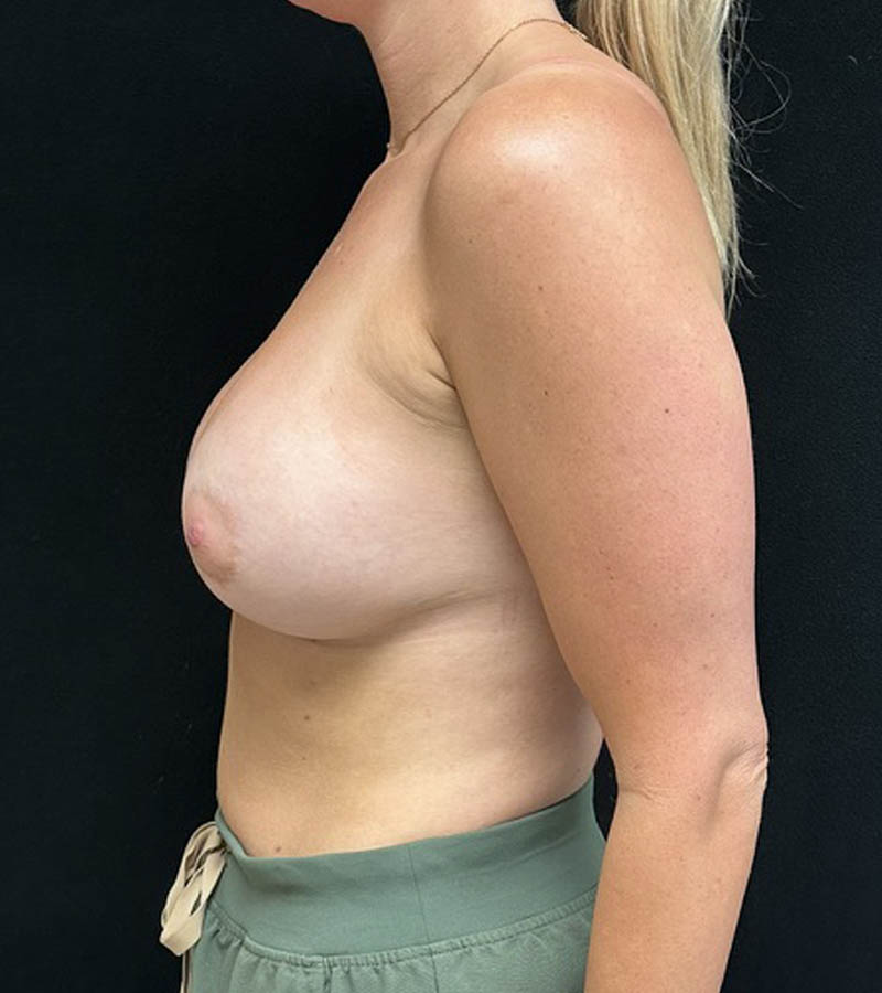Breast Augmentation case #5026