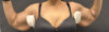 Arm Lift case #5010