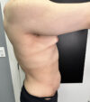 Gynecomastia case #5085