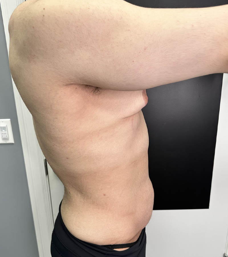 Gynecomastia case #5085